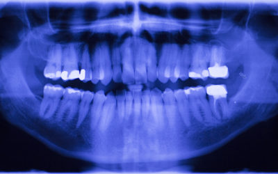 Dental X-Rays – What’s the Purpose?