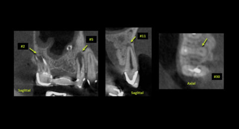 CBCT in Endodontics – Capture 3D Radiology