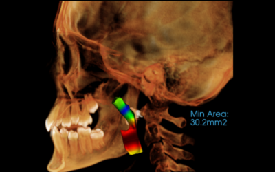 CBCT for Airway Analysis & Dental Sleep Medicine