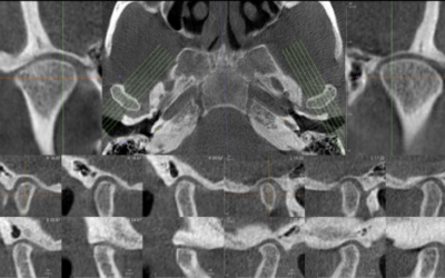 CBCT for the Temporomandibular Joints