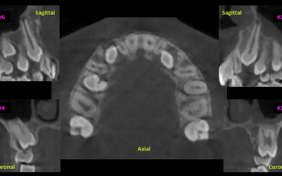 CBCT for Impacted Teeth