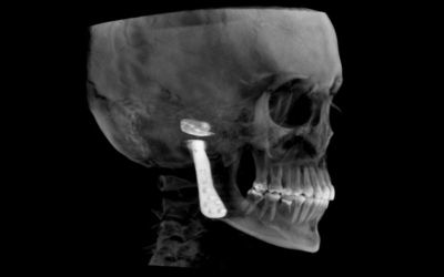 CBCT use for Surgical Planning and 3D Printing